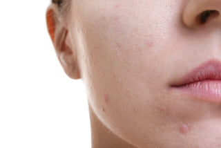 Benzoyl Peroxide and the Risk of Benzene in Acne and Rosacea Products