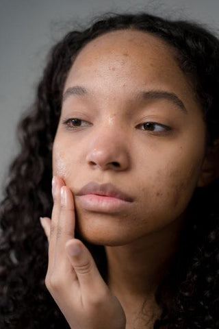 5 Ways to Stop a Zit from Forming