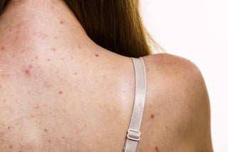 Body Acne Breakouts? This Dermatologist-Trusted Wash Is a Favorite
