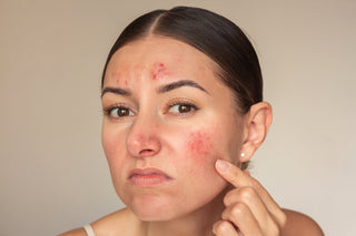 Eczema, Pimples, and Folliculitis: Tackling the Troubled Trifecta