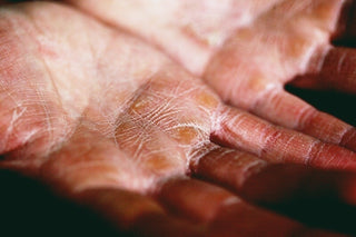 How to Combat Dry Hands in the Colder Months