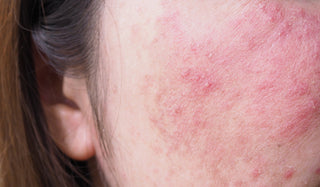 Stripping Your Skin to Clear Acne? Here’s a Better Way