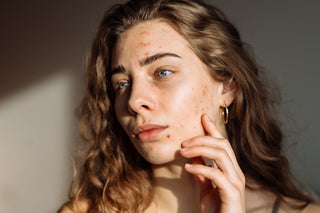 Not All Acne Cleansers Are Created Equal: Comparing Harsh Treatments to CLn Skin Care
