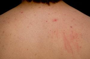 Understanding Folliculitis—An Introductory Guide